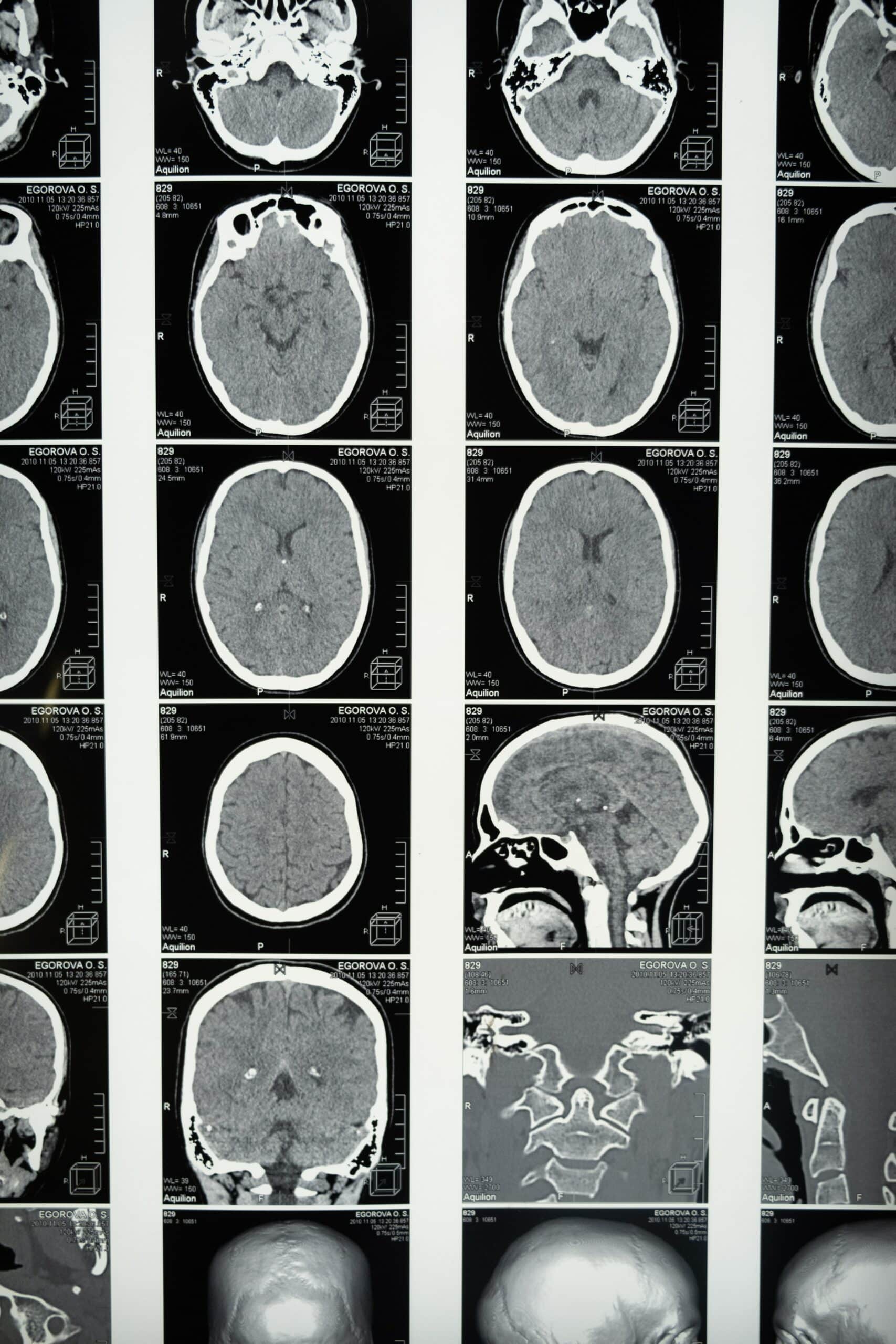 scans of brain